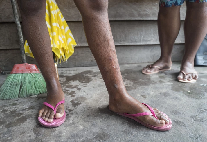 Doenças, sequelas e morte: como gigante do alumínio foi parar na justiça holandesa por contaminação no Pará